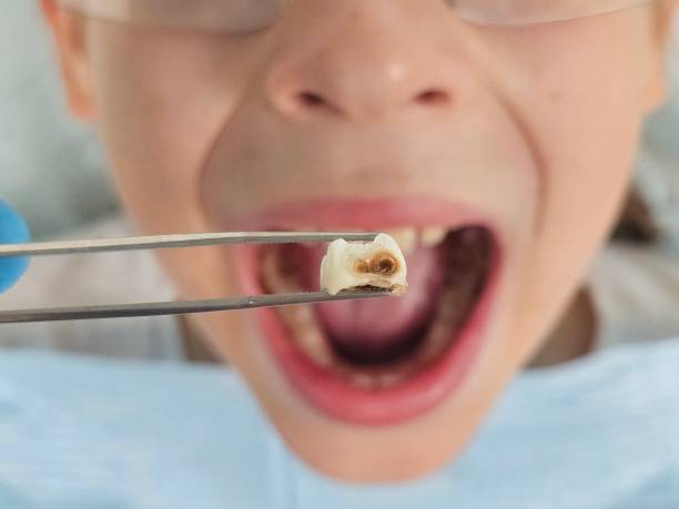 Best Emergency Dental Extractions in Kent City, MI